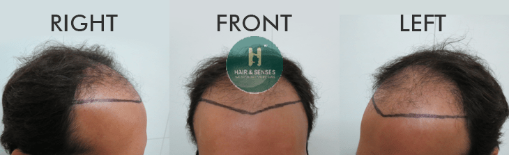 4000 Hairline Designing